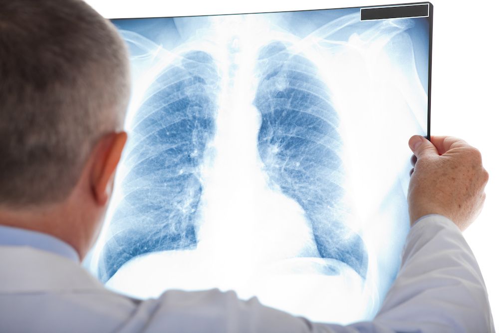 Nódulo pulmonar: ¿Debo preocuparme?