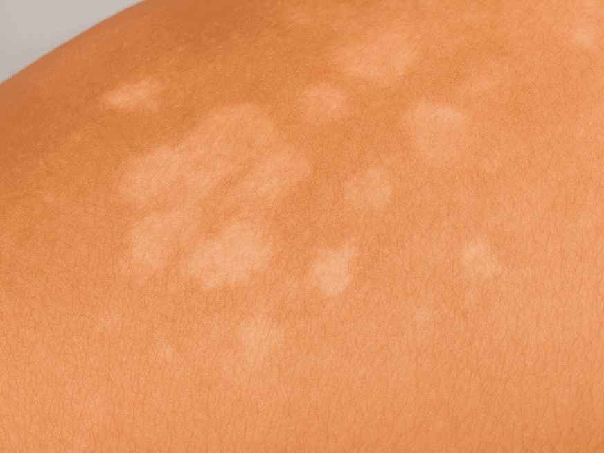 ¿Manchas blancas en la piel que no se broncean? Podría ser Pitiriasis Versicolor.