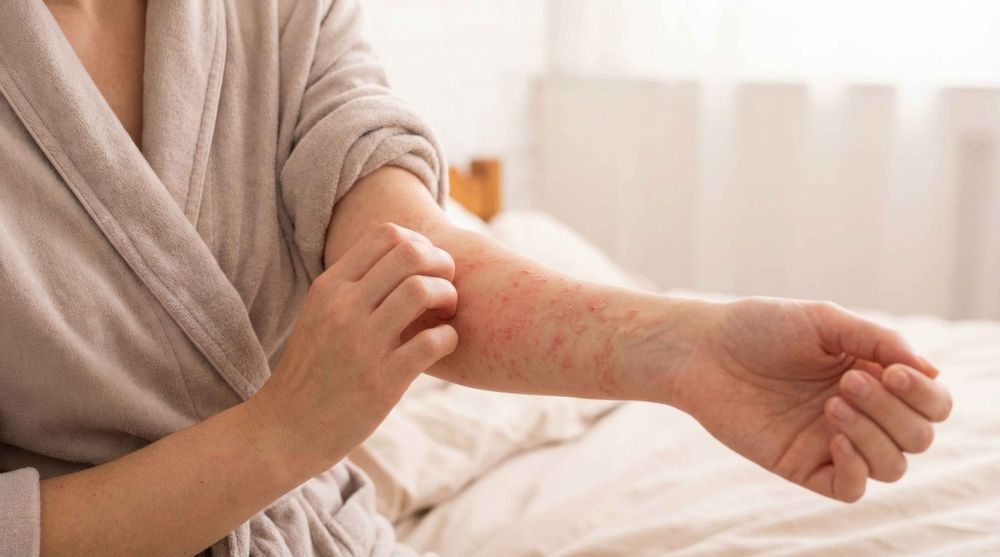 Dermatitis atópica, un problema frecuente