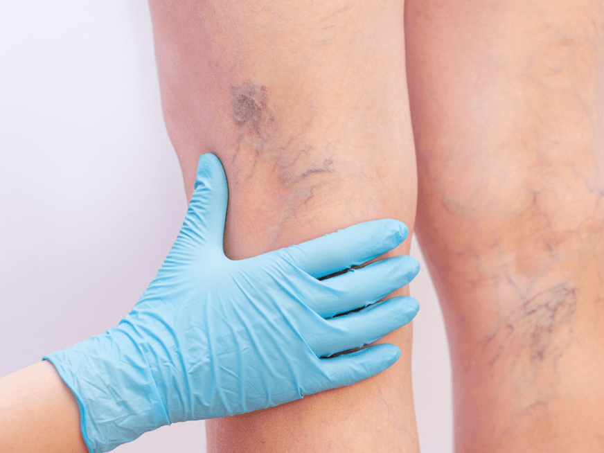 ¿Cómo impacta el calor en pacientes que tienen várices?