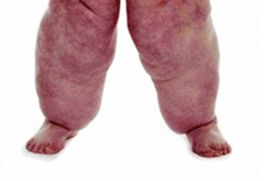 Lipedema: ¿qué es?