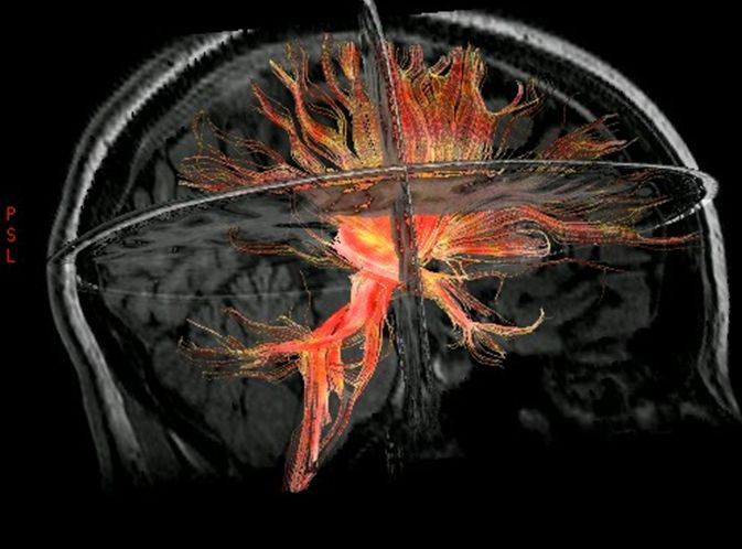 Elocuenciación del dolor utilizando BOLD en reposo
