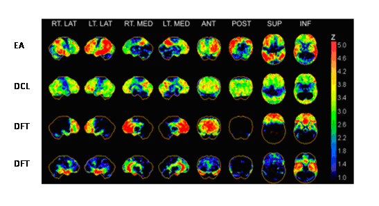 Aplicaciones del PET en el estudio de las demencias