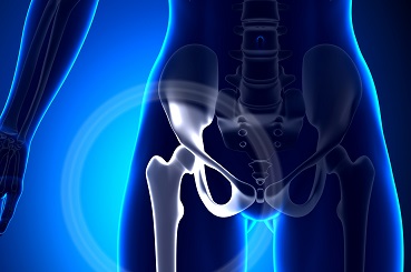 Prótesis de Cadera: la posibilidad de volver a la vida cotidiana