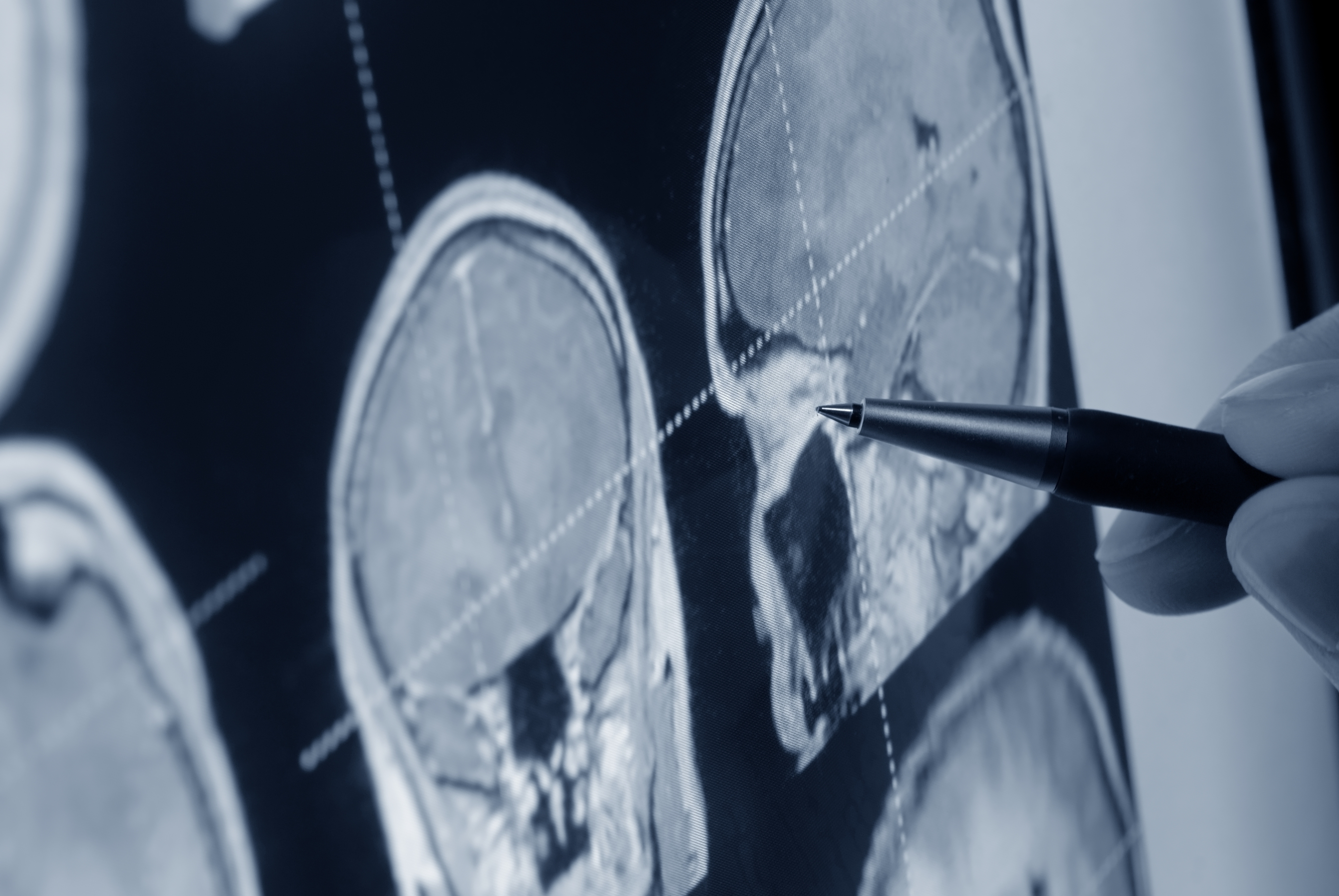 Hipertensión Arterial y Neurociencias