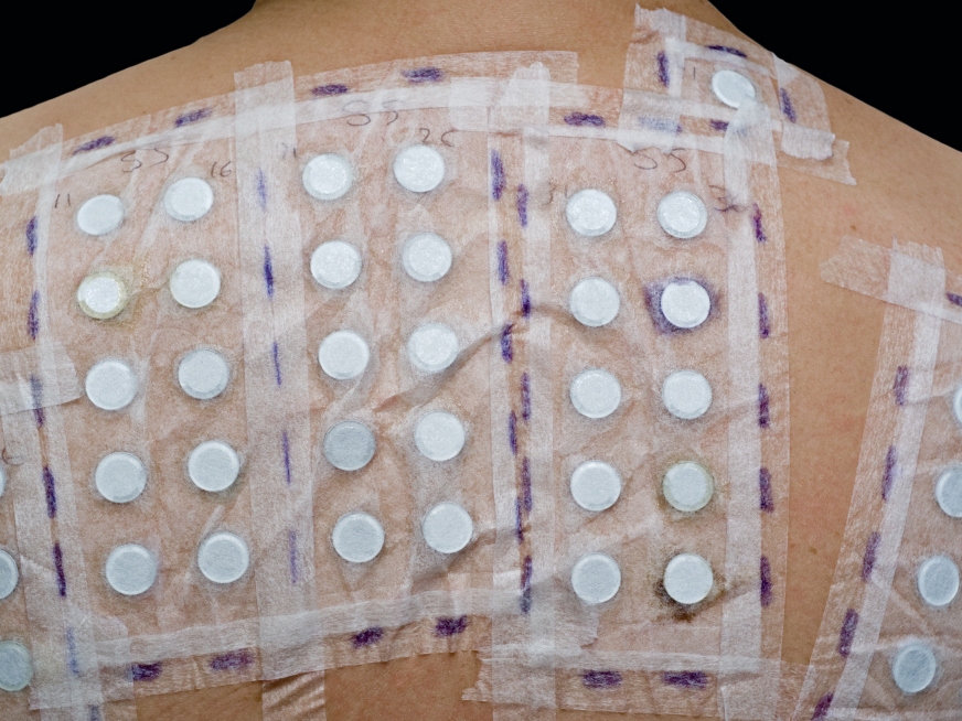 Semana Mundial de la Alergia 2016: síntomas y consecuencias