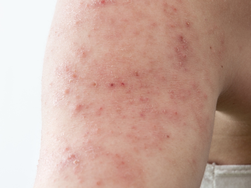 Dermatitis Atópica