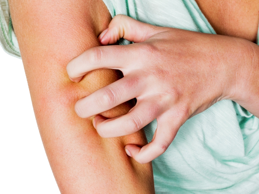 Dermatitis Atópica: Tratamiento