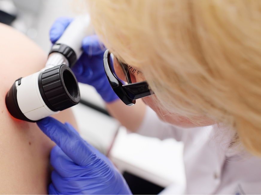 ¿Qué es el Carcinoma Basocelular (CBC)?