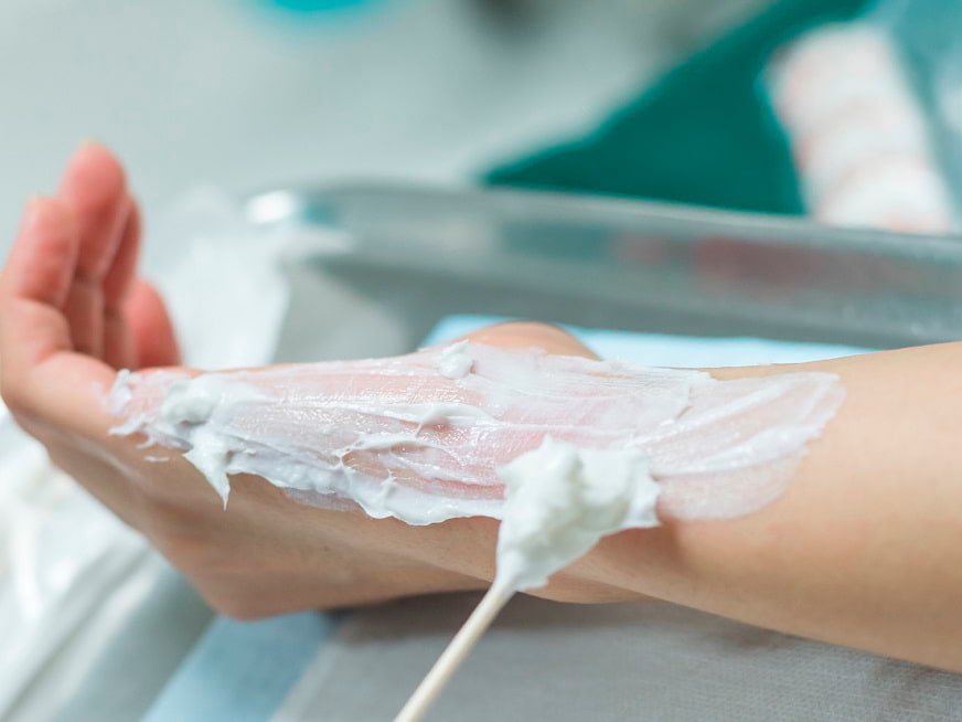 Quemaduras: Medidas a tomar