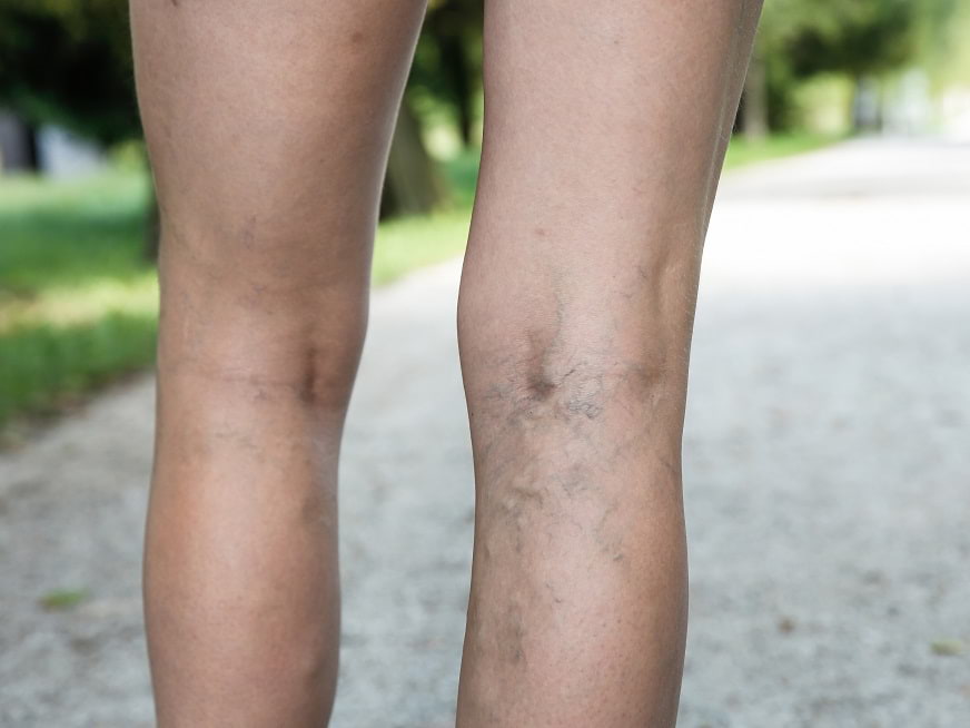 Trombosis venosa: El riesgo de lo impredecible