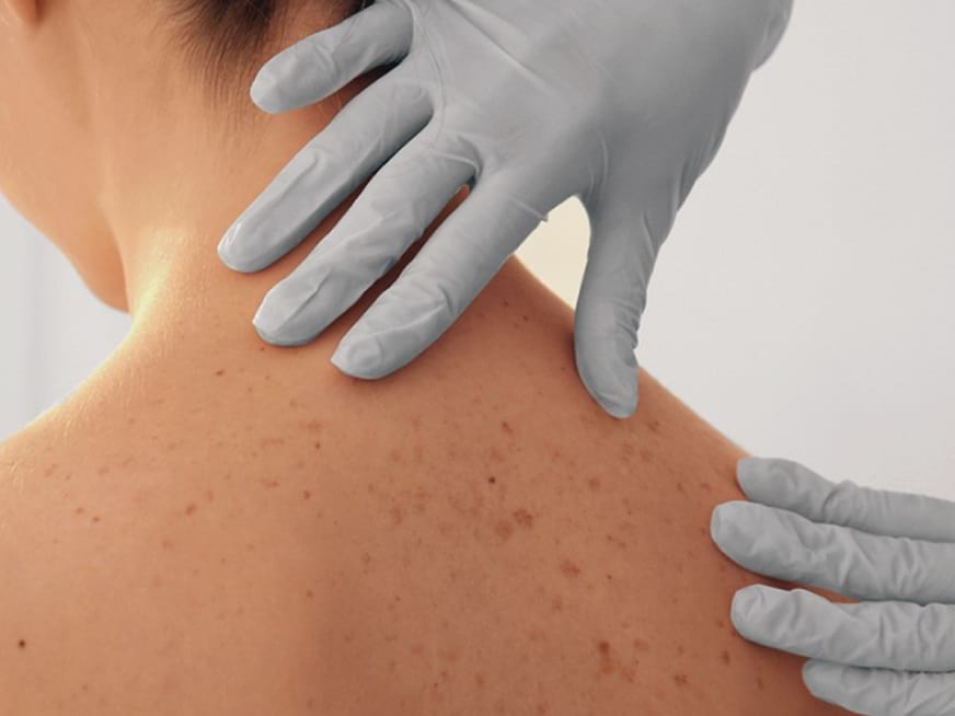 Grupo Gamma se suma a la campaña de prevención de Cáncer de Piel