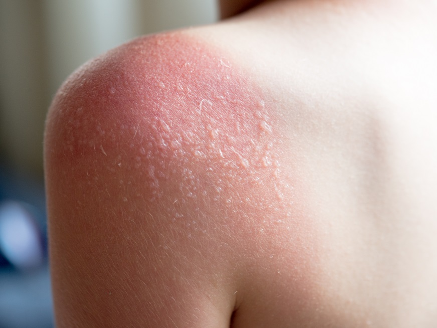 Quemaduras por el sol