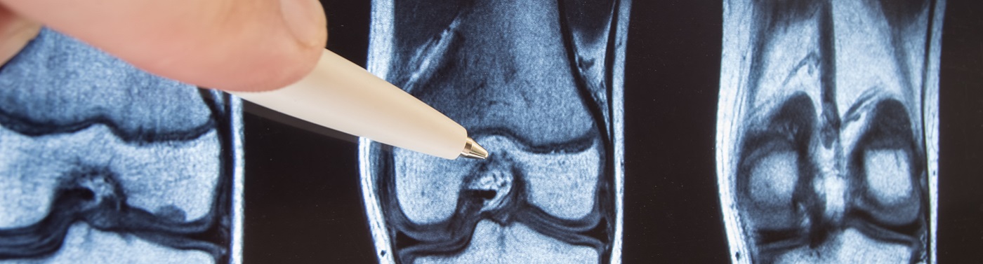 Unidad de Sarcomas Músculo Esqueléticos