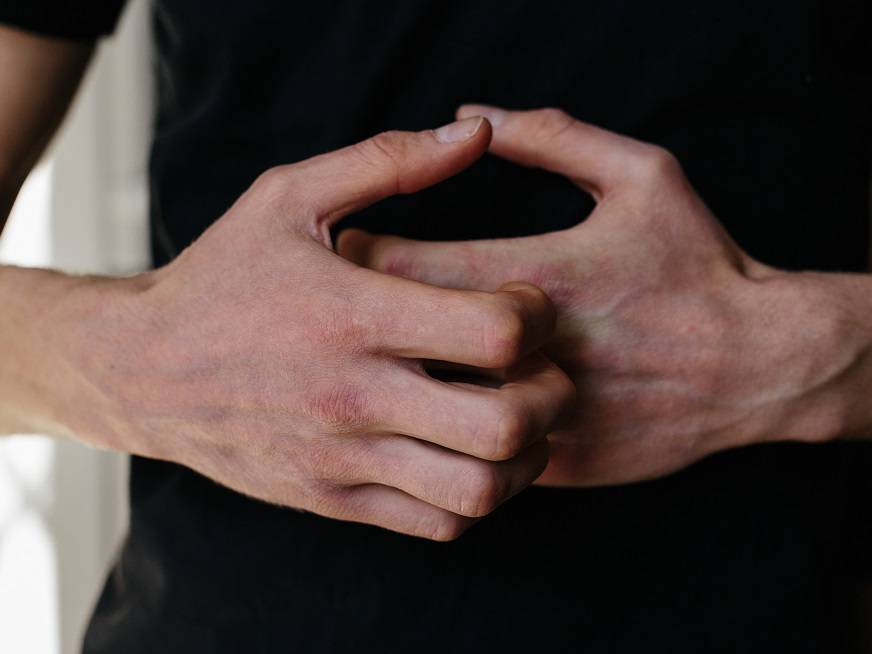 Urticaria en pandemia