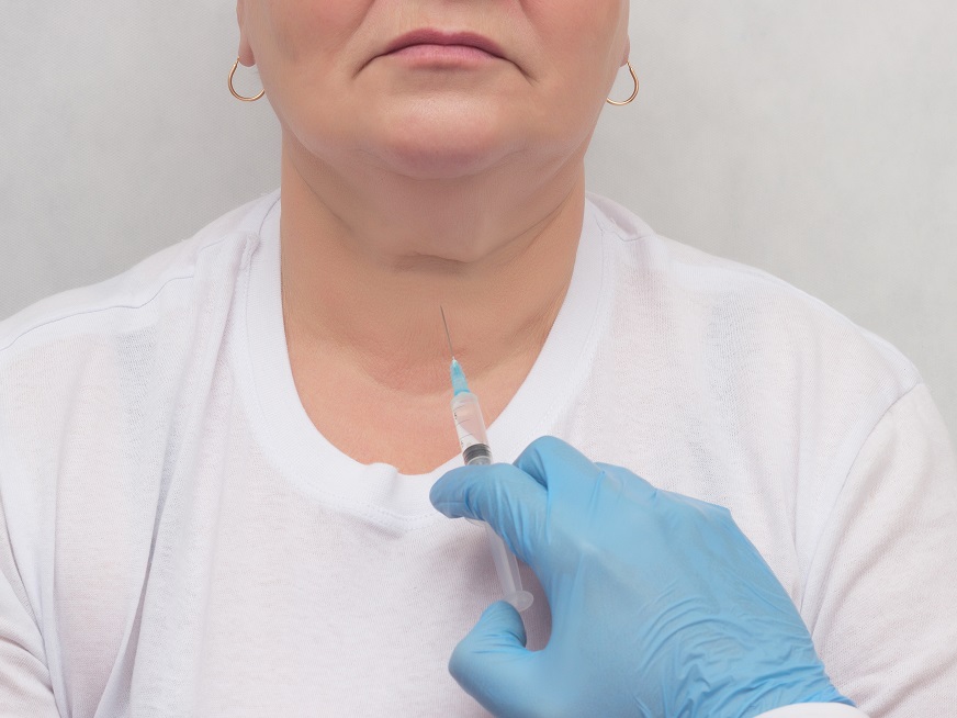 Punción con aguja fina de nódulos tiroideos