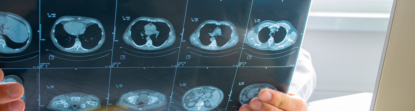 Unidad de Tromboembolismo Pulmonar