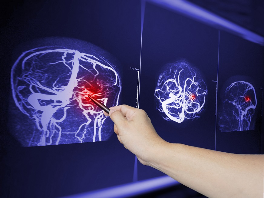 Charla a la comunidad | Día Mundial del ACV
