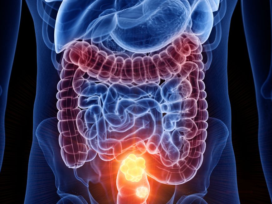 Cáncer Colorrectal: la importancia del diagnóstico precoz