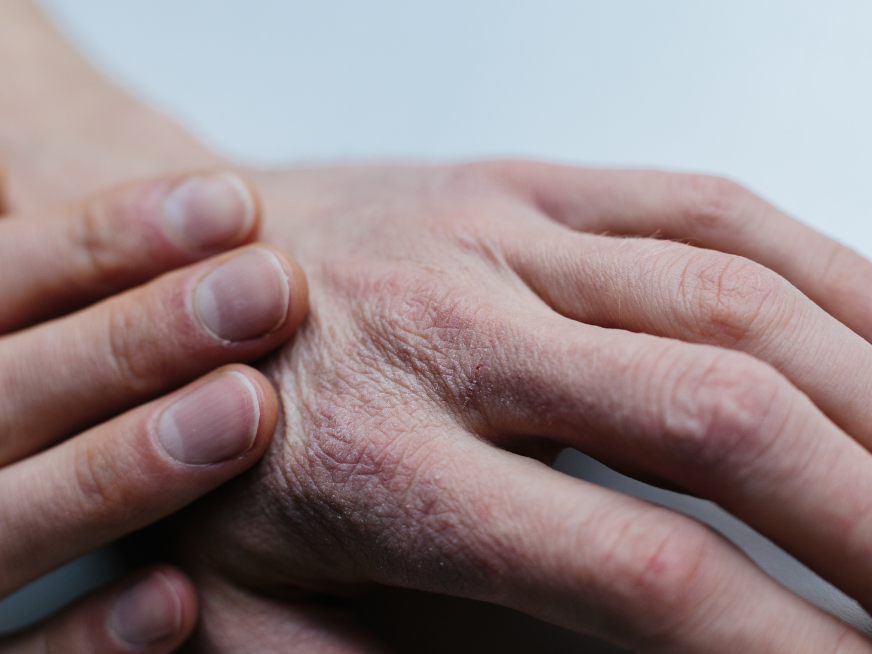 Esclerosis Sistémica: Información clave sobre la enfermedad