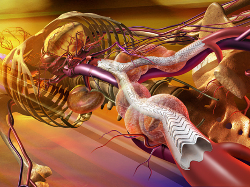 AERO III Plus: Aorta Endovascular Rosario + Peripheral Interventions