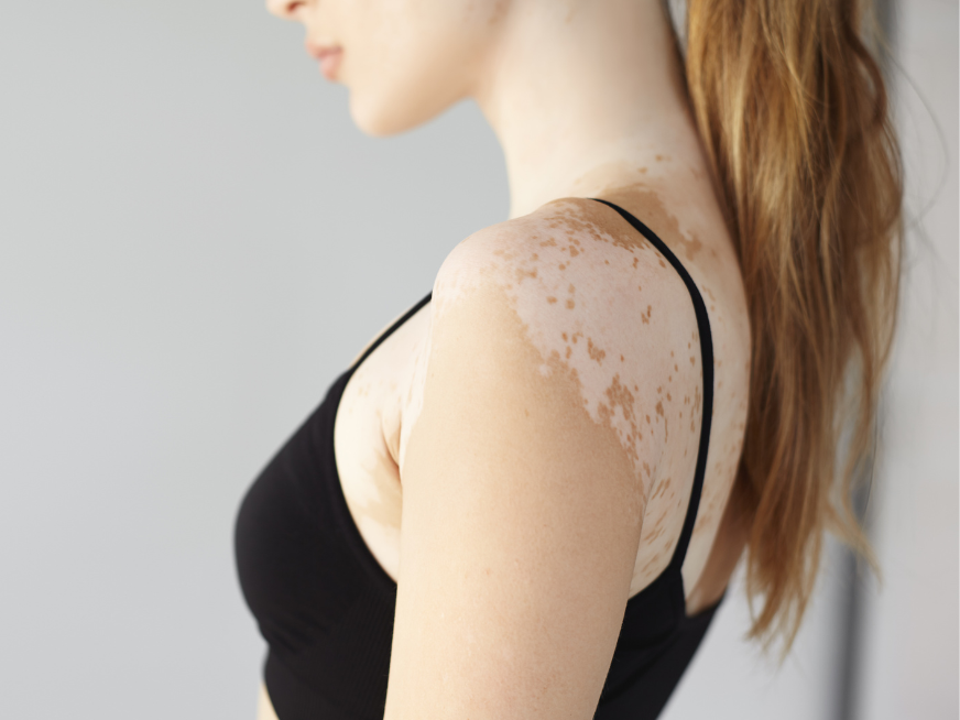 Vitiligo ¿Cómo cuidarse del sol?