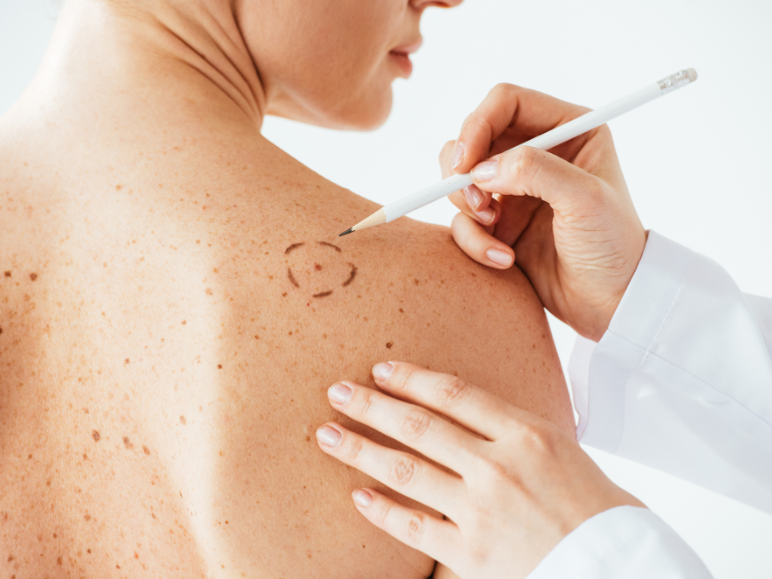 Melanoma: enseñar para prevenir