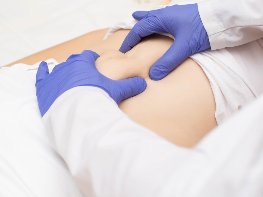 Hernias abdominales: ¿Cómo tratarlas?