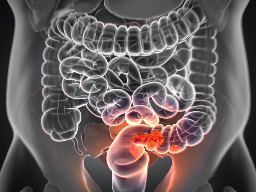 Prevención del Cáncer Colorrectal en el Día Mundial