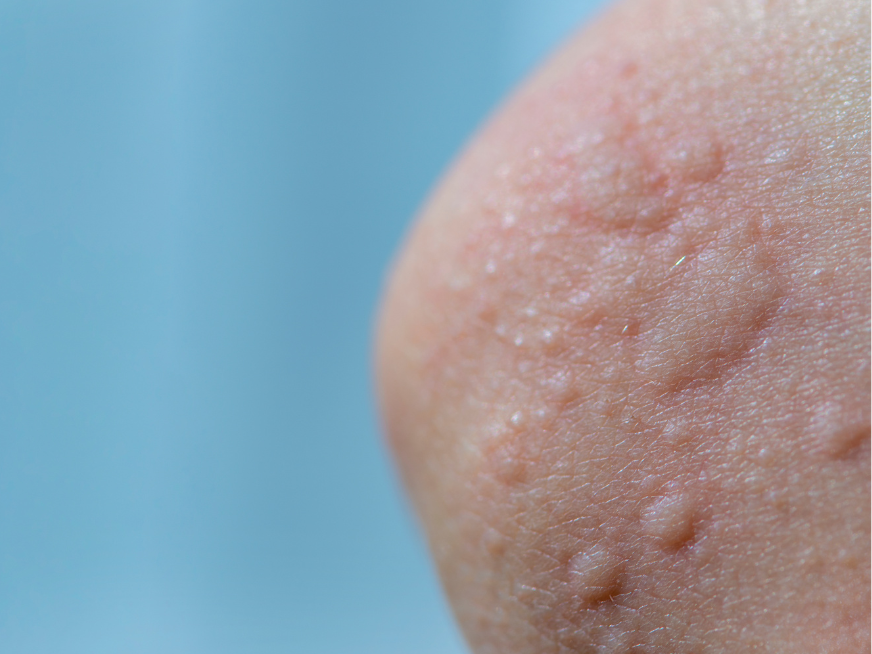 ¿Qué es la urticaria? ¿Cómo se trata?