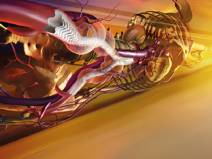 AERo + | Aorta Endovascular Rosario 4ta edición: Técnicas Endovasculares Avanzadas en Enfermedad Arterial Periférica II