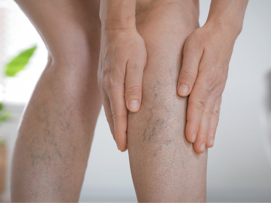 ABC SCITE: aprendizaje basado en casos ¿Cuándo pensar en intervenciones endovasculares en pacientes con trombosis venosa profunda?